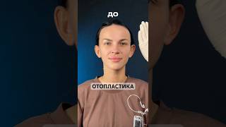 Otoplasty 68