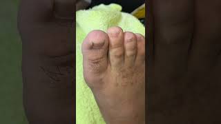 Ep_8303 Foot nails skin removal 👣 หนูเป็นหนังค่ะ..ไม่ได้เป็นเล็บขบ 😄 (clip from Thailand)