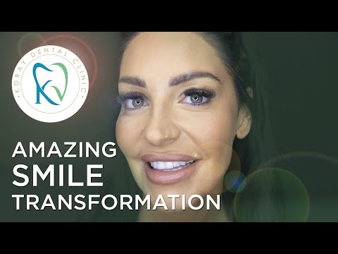 HOLLYWOOD SMILE | AMAZING SMILE TRANSFORMATION OF REBECCA