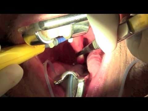 Treatment of laryngeal papillomatosis