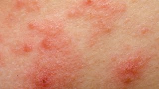 How to Get Rid of Rosacea Naturally - Rosacea Treatment