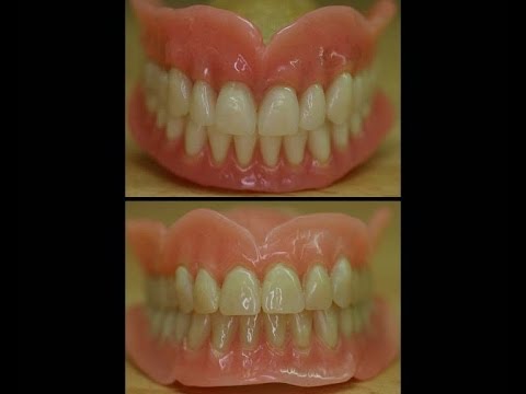 Eine Hybridprothese bietet mehr Komfort als die klassische Totalprothese