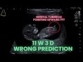 Ultrasound Pregnancy Wrong Gender prediction. WHY?