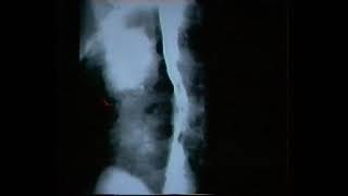 Lung cancer 2