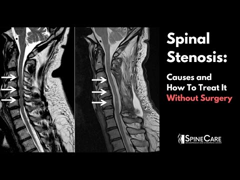Spinal Stenosis: Causes and How to Treat It Without Surgery
