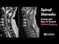 Spinal Stenosis Causes And How To Treat It Without Surgery