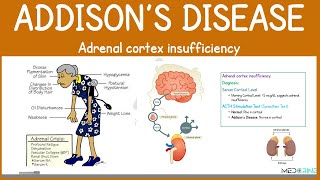 Addison’s Disease & Addisonian Crisis | Causes, Diagnosis, Symptoms, Diagnosis & Interventions