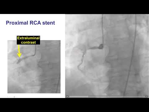 Managing PCI Complications. Dr Manos Brilakis. Dec 17 2025