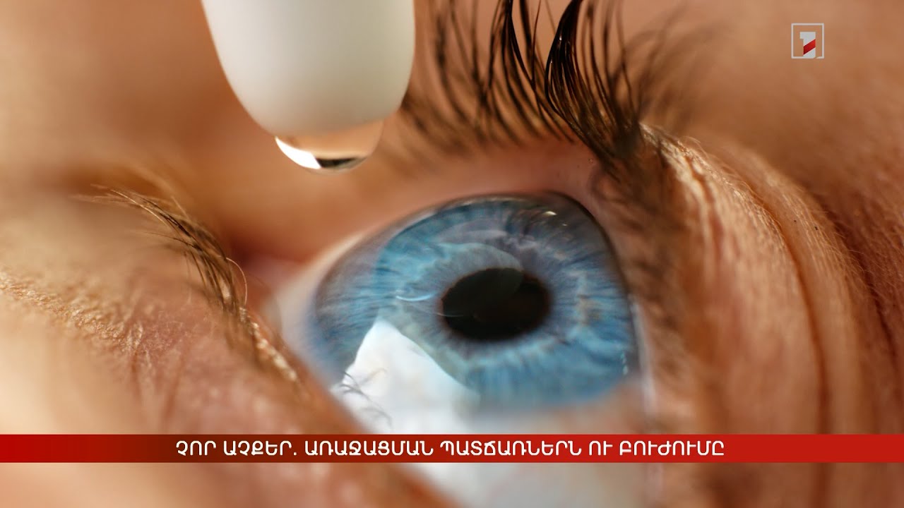 Չոր աչքեր. առաջացման պատճառներն ու բուժումը