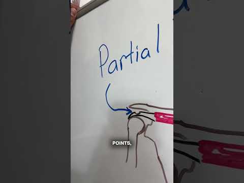 Type Of Rotator Cuff Tears Explained