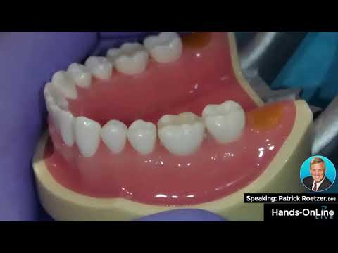 Removing Composite Overhangs with Patrick Roetzer, DDS