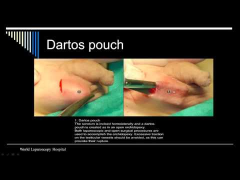 Laparoscopic Assisted Orcheopexy for Undescended Testes