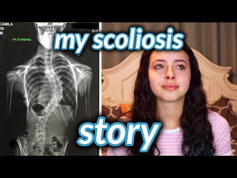  My Scoliosis Surgery Story: I still dance with a fused spine