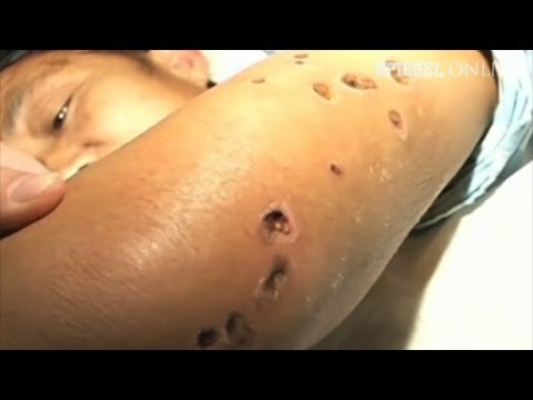 Hypertonische Salzlösung Losartan Teva 100