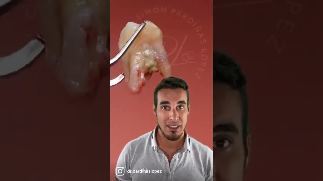 ♦️La IMPORTANCIA de QUITAR el SARRO de tus dientes - Muela que se mueve