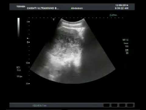 Lyambliya komarovskiya a sintomi di bambini e trattamento Che esso è possibile togliere intestini da parassiti