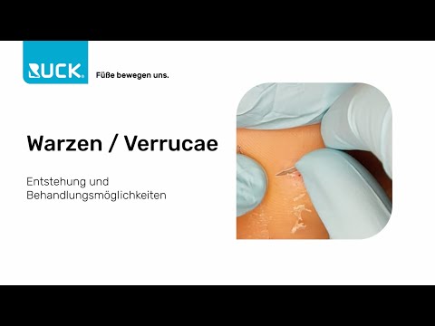 Warzen an den Füßen - wie wird man sie schnell los?