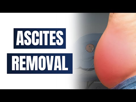 Removing Ascites Fluid: Paracentesis Explained