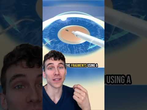 How Cataract Surgery Is Done (Cataract Surgery Animation)