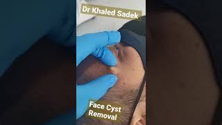 #cystremoval #blackheads #pimples #drkhaledsadek Dr Khaled Sadek Lipomacyst.com