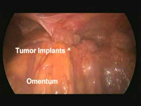 Recurrent Uterine And Ovarian Cancers - Estimation