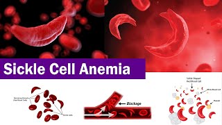 Sickle Cell Anemia ( Complete & Clear Explain )