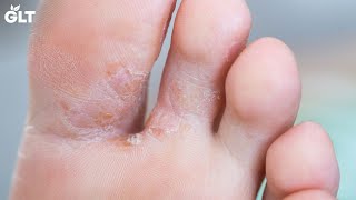 7 Ways To Treat Foot Fungus Easily At Home
