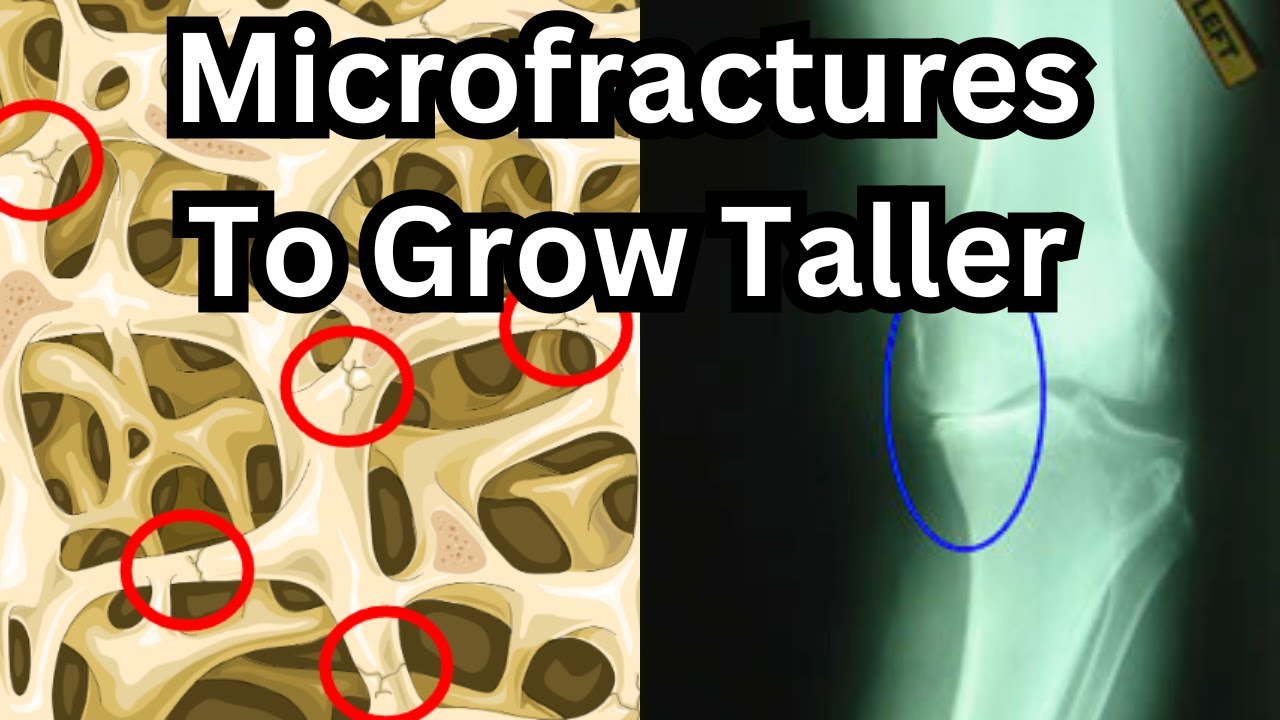 How To Grow Taller After Puberty: Full Microfracture Guide (with real-life examples)