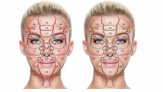 Plasma rico em Plaquetas funciona para o Melasma