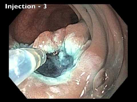 Sigmoid Colon - A Large Lesion