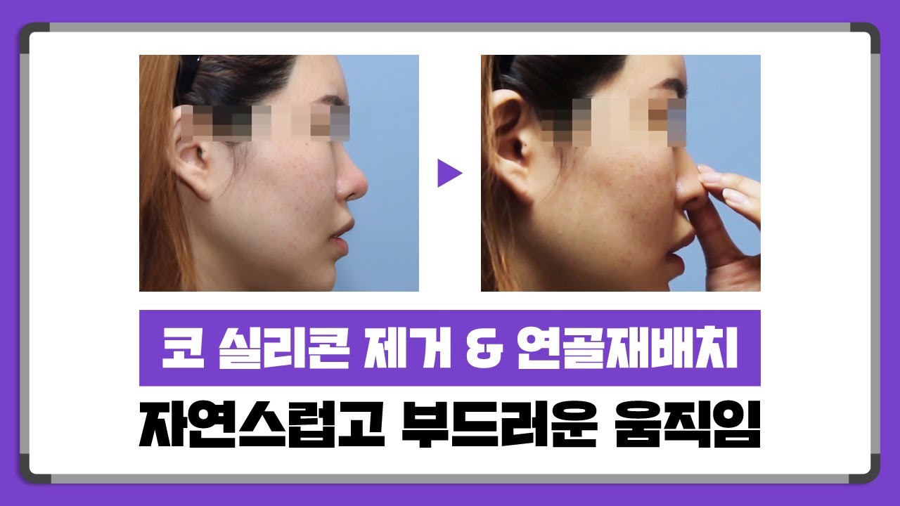 코 보형물제거 후 코끝의 움직임 썸네일