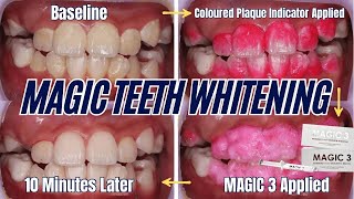 Clinical Case Discussions for Teeth Whitening ft Dr Wyman Chan (MAGIC Part 2)