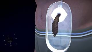 3d medical animation ostomy device design part1
