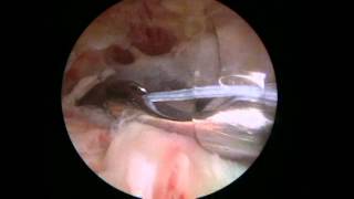 preview picture of video 'Arthroscopic rotator cuff repair - double row - Dr. Laith Farjo, Brighton, Michigan'