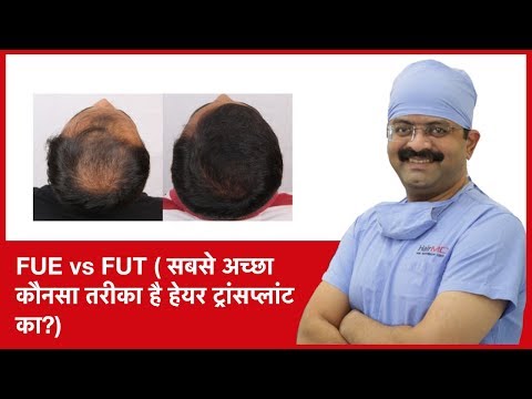 FUE vs FUT: Which one is a best method of hair transplant | HairMD, Pune | (In HINDI)