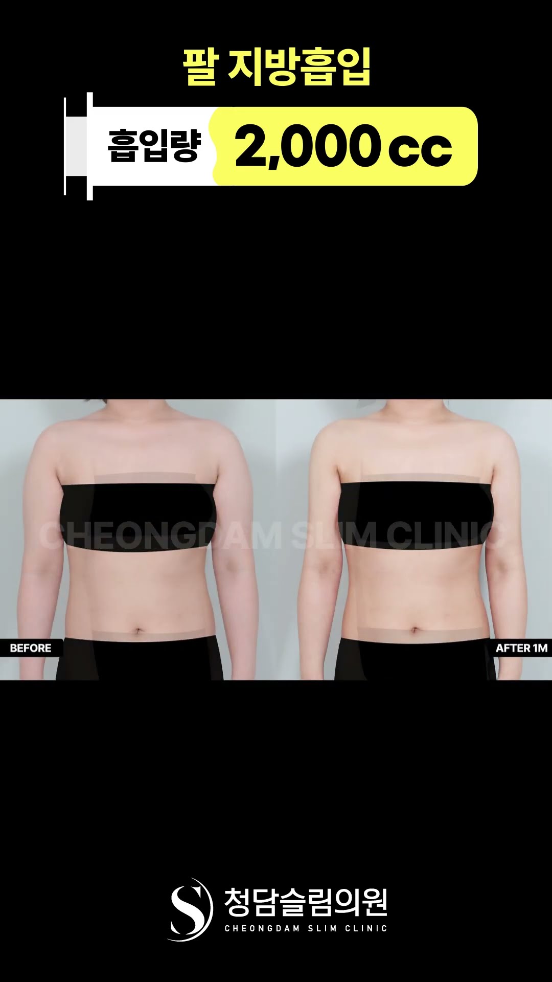 팔 라인 때문에 스트레스라면 ✨