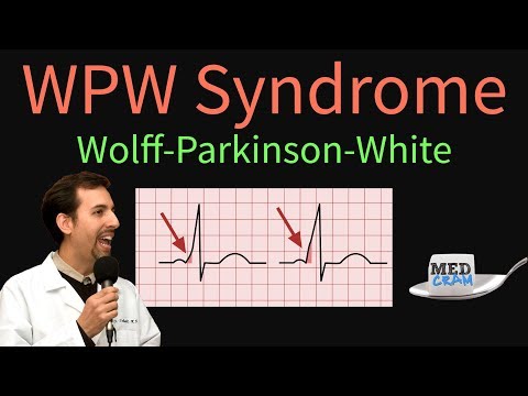 WPW / Wolff-Parkinson-White Syndrome: ECG / EKG findings, symptoms, pathology, & treatment