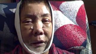 My Complete Facial Plastics Rejuvenation Video Blog & Diary 04
