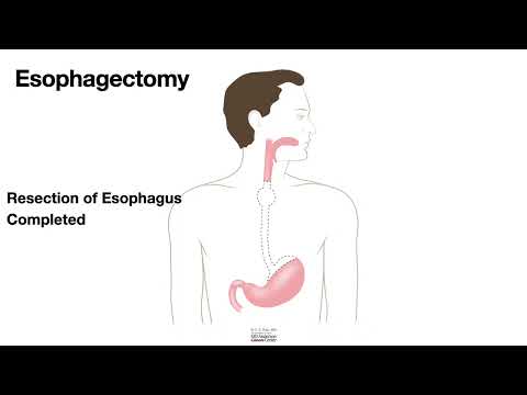 HCC 1475-10a - Surgical Anatomy - Esophagectomy