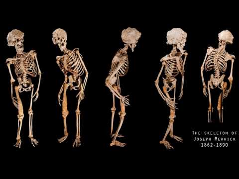 The Life and Death of Joseph Carey Merrick by Sir Frederick Treves (Audiobook) #josephmerrick