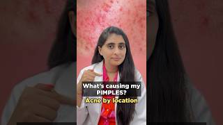 Download lagu Pimples on face | How to treat acne and pimples on face | What acne means | Dermatologist mp3