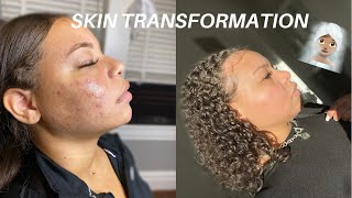 HOW I CLEARED MY ACNE FOR GOOD *SKIN TRANSFORMATION*
