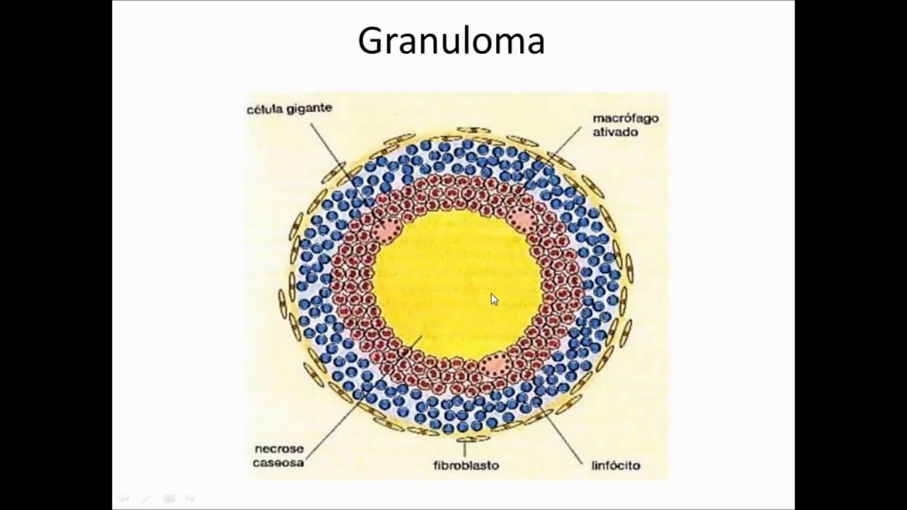 Monitoria - Inflamação (Patologia)