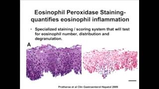 Recent Research Findings for Eosinophilic Disorders (Webinar Recording)