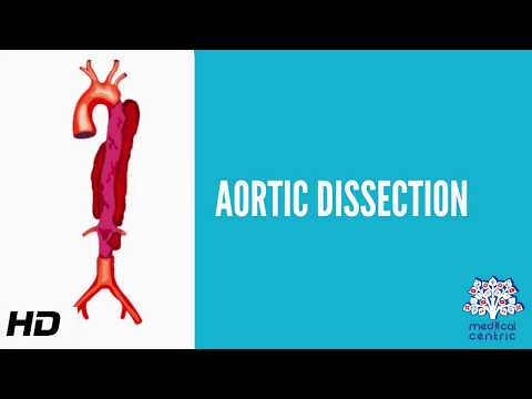 Aortic dissection (AD), Causes, Signs and Symptoms, Diagnosis and Treatment.