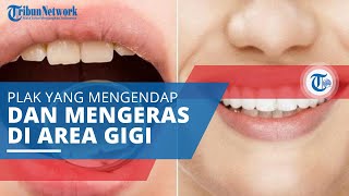 Karang Gigi, Plak yang Mengendap dan Mengeras di Permukaan Gigi
