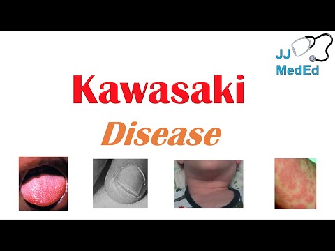 Kawasaki Disease | What is it, symptoms, treatment and complications (ex. heart failure)