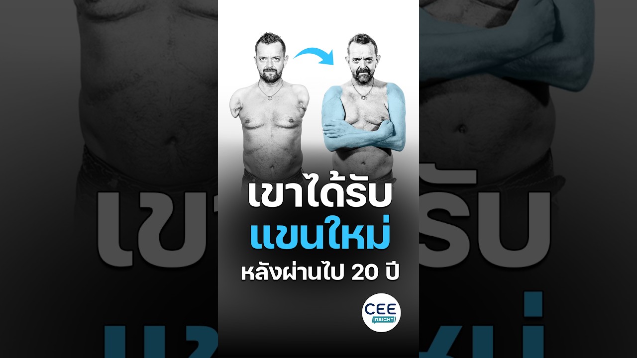 เขาได้แขนทั้งสองข้างใหม่ หลังจากรอมานาน 20 ปี