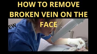 How to Get Rid of Broken Veins on the Face