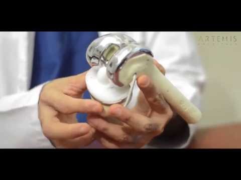 download lagu mp3 mp4 Free Knee Replacement Surgery In Pune, download lagu Free Knee Replacement Surgery In Pune gratis, unduh video klip Free Knee Replacement Surgery In Pune